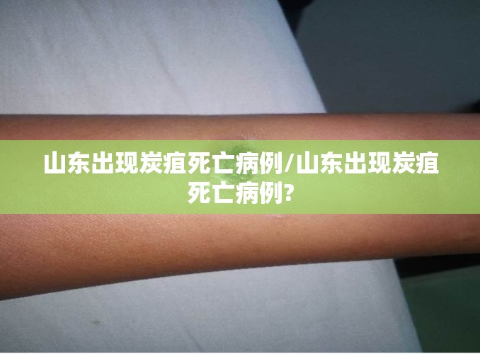 山东出现炭疽死亡病例/山东出现炭疽死亡病例?